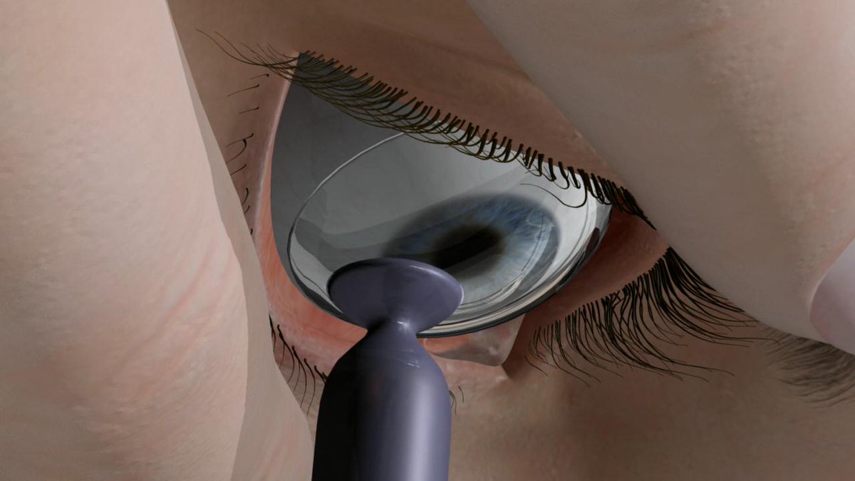 ow.ly/OK2K104z3j6 ow.ly/li2B104z3j5 Using technology to manage corneal challenges before cataract ... - Ophthalmology Times