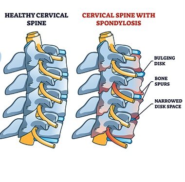 𝗦𝗽𝗼𝗻𝗱𝘆𝗹𝗼𝘀𝗶𝘀- 
𝗗𝗲𝗴𝗲𝗻𝗲𝗿𝗮𝘁𝗶𝘃𝗲 osteoarthritis: Mainly involving the joints between the vertebral body an...
