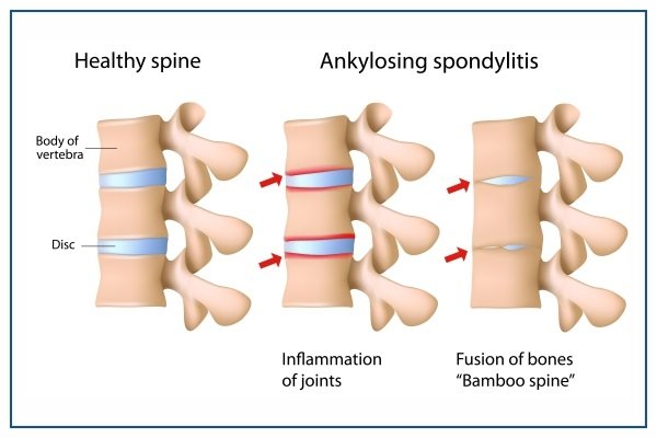 𝗦𝗽𝗼𝗻𝗱𝘆𝗹𝗶𝘁𝗶𝘀- 
𝗜𝗻𝗳𝗹𝗮𝗺𝗺𝗮𝘁𝗼𝗿𝘆 arthritis:specifically sacroiliac &amp; facet joints -->with multiple...