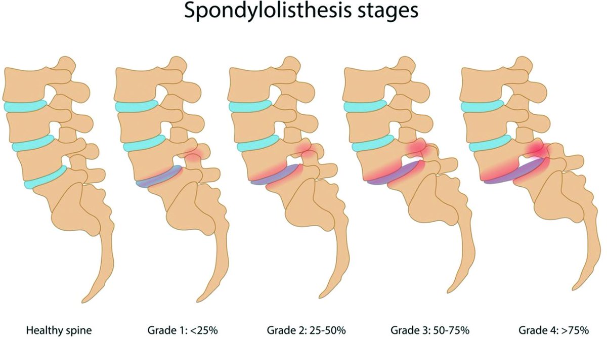 𝗦𝗽𝗼𝗻𝗱𝘆𝗹𝗼𝗹𝘆𝘀𝘁𝗵𝗲𝘀𝗶𝘀(mostly L5-S1)-
Spinous-process fracture--> Breakaway of vertebral body from spi...