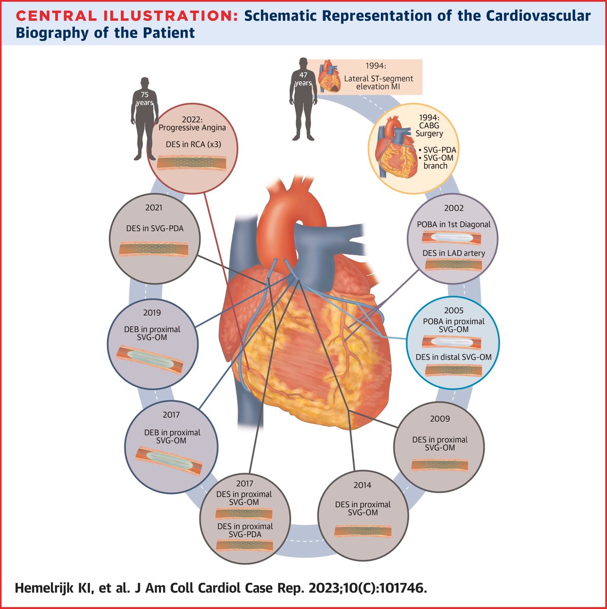 Mladen Vidovich (@mividovich) on Twitter photo (Almost)-Complete history of PCI summarized in a 1500 words case report👉🏻 #JACCCaseReports @jaccjournals jacc.org/doi/10.1016/j.… <a href="/JGrapsa/">Julia Grapsa</a> (Almost)-Complete history of PCI summarized in a 1500 words case report👉🏻 #JACCCaseReports @jaccjournals jacc.org/doi/10.1016/j.… <a href="/JGrapsa/">Julia Grapsa</a>