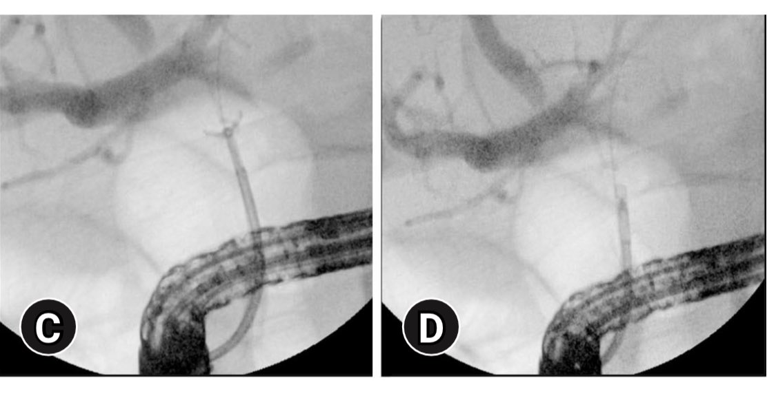 BilalMohammadMD's tweet photo. Histological dx of #BiliaryStrictures cont to be a challenge
Our prelim experience of “Wire Guided Bx Forceps” (Old concept + 💵 effective) 👇
✅ 100% tech success
✅ 83% clini success
✅ Dx accuracy > Brushings alone
Good 🔨to have in Endoscopists 🧰
https://t.co/tkKWC1KJR4 https://t.co/AOwzCiyD3q