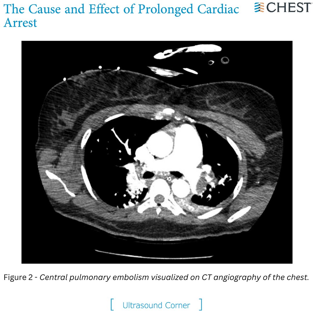 CHEST (@accpchest) on Twitter photo Ultrasound Corner: The Cause and Effect of Prolonged Cardiac Arrest
Read the full research in the March <a href="/journal_CHEST/">CHEST® Journal</a> issue: hubs.la/Q01H4xkY0
#MedTwitter #MedEd #CardioTwitter Ultrasound Corner: The Cause and Effect of Prolonged Cardiac Arrest
Read the full research in the March <a href="/journal_CHEST/">CHEST® Journal</a> issue: hubs.la/Q01H4xkY0
#MedTwitter #MedEd #CardioTwitter