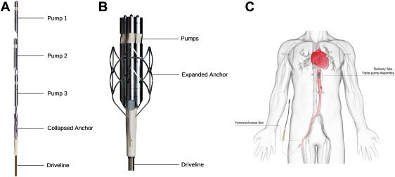 Day 3 at #SIF2023: @PhilGenereuxMD on novel perc MCS + renal perf ModulHeart @PuzzleMedical —
☑️ 3 pumps in series, assembled in parallel
☑️ ⏫️ CO 25%, UOP ⬆️ 9x, LVEDP ⏬️ 78%
☑️ 14Fr/10Fr fem/ax, <10mins
☑️ FIH published in @MyJSCAI — jscai.org/article/S2772-…
🤯 up to 10LPM!