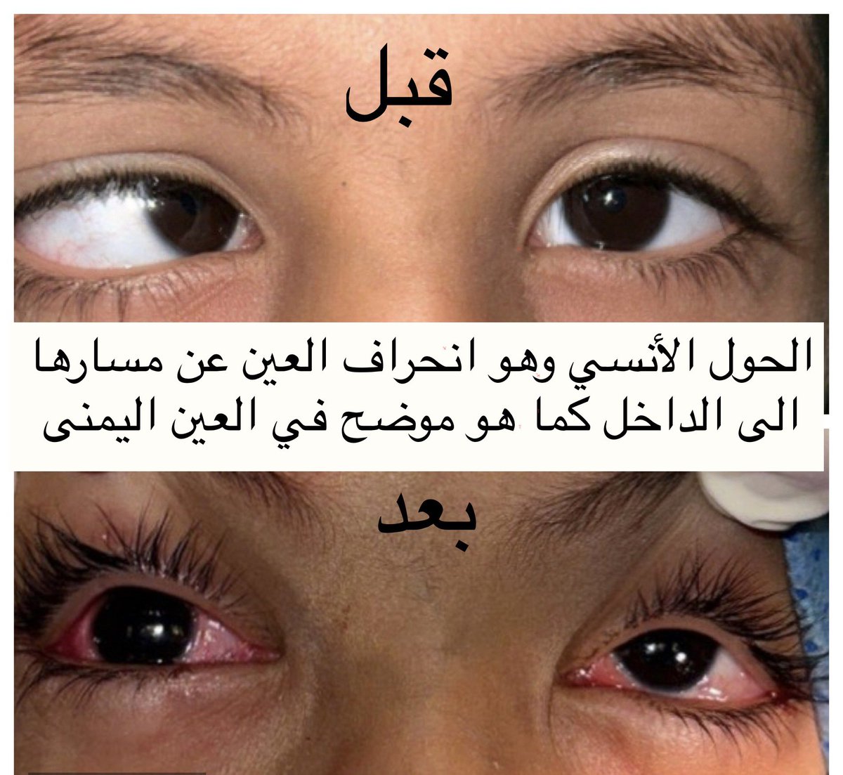 na3oma60's tweet photo. تم بحمدالله إجراء عمليات متعددة لمختلف انواع مرضى الحول في المستشفى العسكري تبوك انطلاقاً من تبادل الخبرات في المستشفيات العسكرية (خدمة الطبيب الزائر ) شعور جميل بعد إنجاز المهمة ومتابعة نتائج العمليات كل الشكر والإمتنان لمنحي هذة الفرصة لخدمة المرضى https://t.co/6hlr7ExhSn
