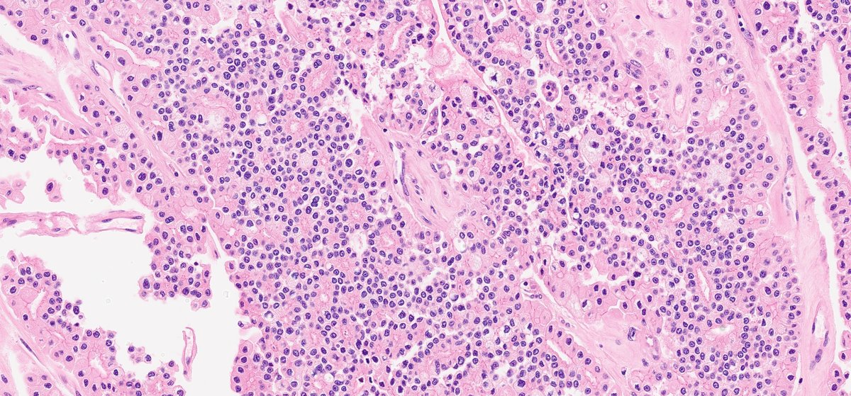 #GUpath nephrectomy:
uncommon adenomatous pattern chromophobe RCC

usually👀background more typical chromoRCC elements &amp; stains as chromoRCC

😲when not recognized or on core bx🚨, DDx widens significantly (other pink renal tumors, urothelial ca w/glandular diff, mets)

⏬ref's