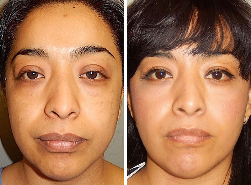 Eyelid Surgery in Beverly Hills CA – Is eyelid surgery worth it? Ask a specialist rodeodriveplasticsurgery.com/eyelid-surgery…