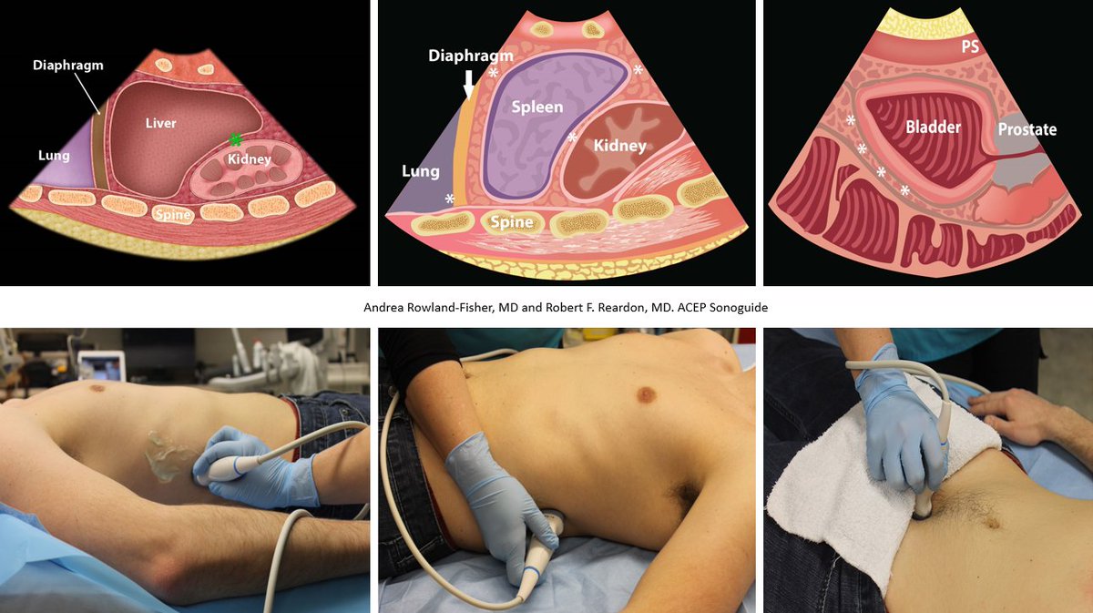 Friday #POCUS classics
#FAST
🔗acep.org/sonoguide/basi…
#MedEd #IMPOCUS #FOAMed