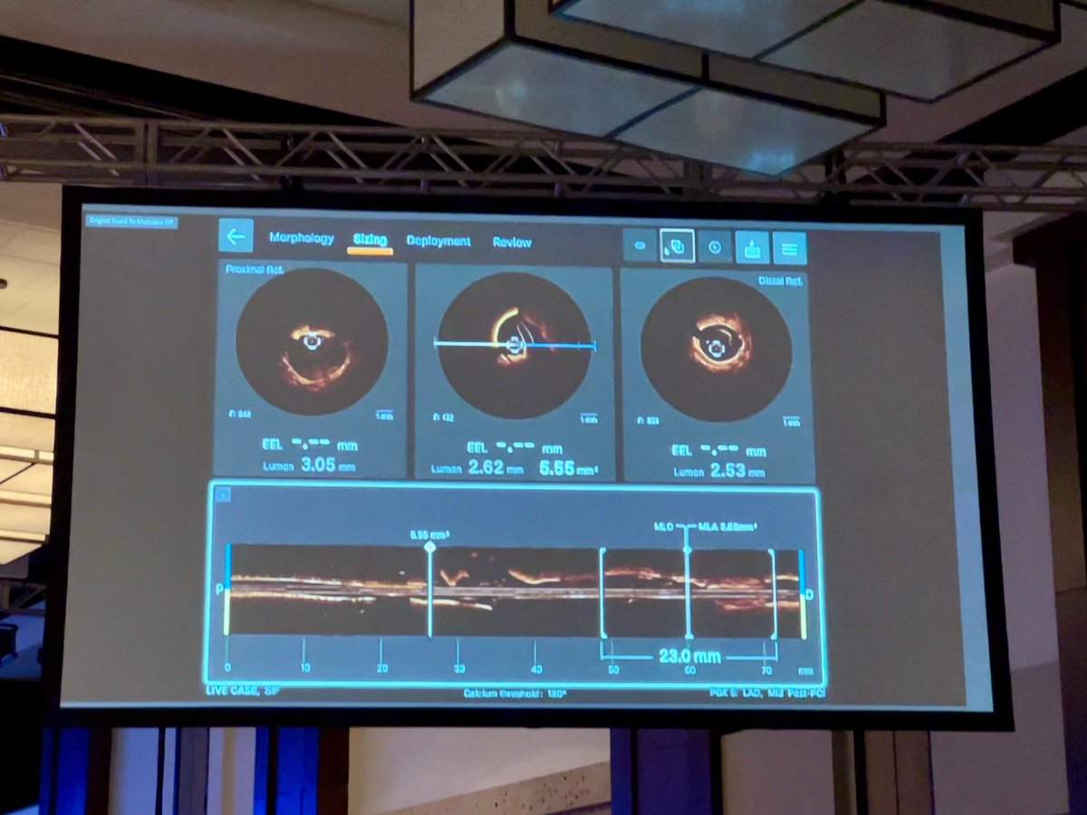 ShockwaveIVL's tweet image. Great #RotaShock live case at #SIF2023 by Drs @AlokSharma081 @Herms2James @RizikMd &amp;amp; Richard Shlofmitz. Imaging with #OCT &amp;amp; #IVUS, @HonorHealth team used a 3.0 &amp;amp; 4.0 #ShockwaveC2 to treat concentric LAD Ca2+ &amp;amp; LM nodular Ca2+ for an excellent result!
ISI bit.ly/3iEq7fc