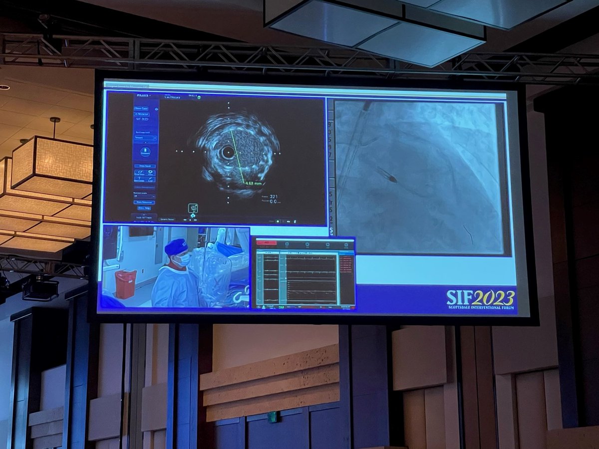 ShockwaveIVL's tweet image. Great #RotaShock live case at #SIF2023 by Drs @AlokSharma081 @Herms2James @RizikMd &amp;amp; Richard Shlofmitz. Imaging with #OCT &amp;amp; #IVUS, @HonorHealth team used a 3.0 &amp;amp; 4.0 #ShockwaveC2 to treat concentric LAD Ca2+ &amp;amp; LM nodular Ca2+ for an excellent result!
ISI bit.ly/3iEq7fc