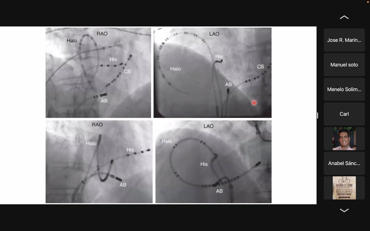 georgedrln's tweet photo. Flutter Auricular , clase por Dr. Aris Villar Pantaleón, gracias por la invitación  @dulceavril11 @mikellinero , @GautierHospital https://t.co/hdTu3xLehq