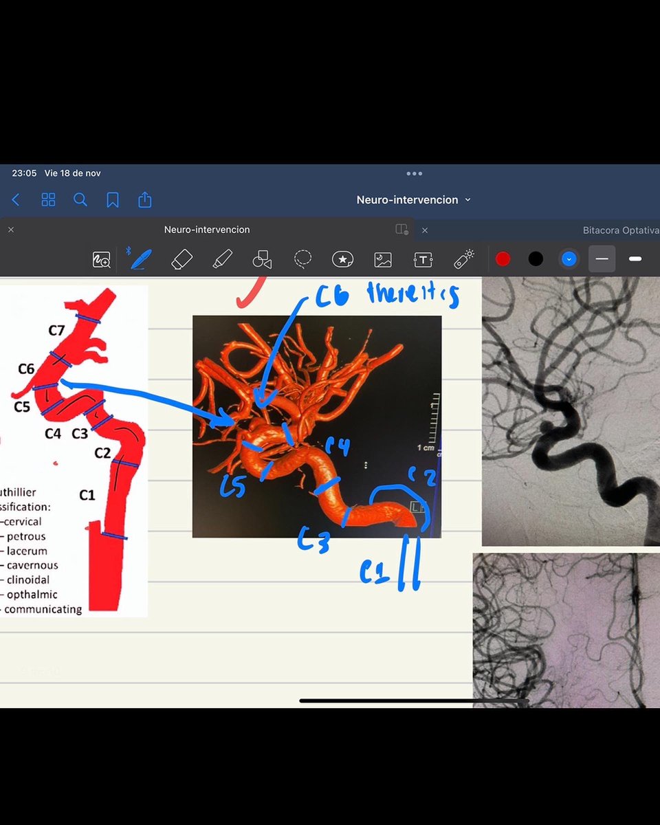 I treasure and remember those 2 months with great fullness, for the opportunity to get into procedures everyday, and learn with the amaizing Dr Orlando Díaz and the best team, my friend Valeria Ortega, who’s also #futureradres we were happy 🥲 (still happy now but missing 😂)