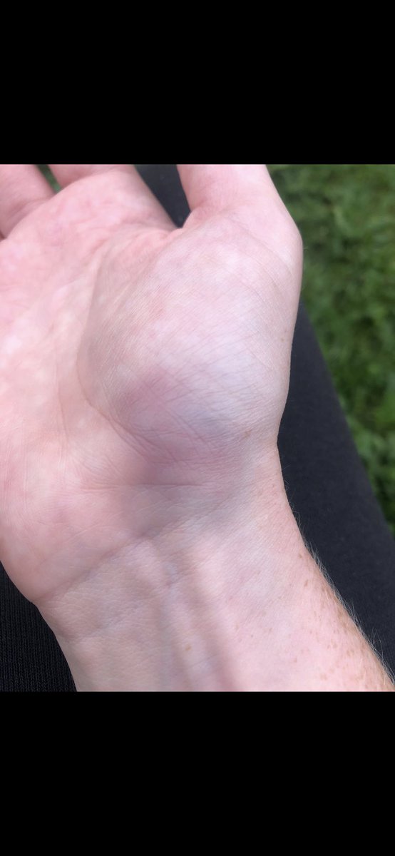 LCDLou on Twitter "My right hand was the most painful ever at the