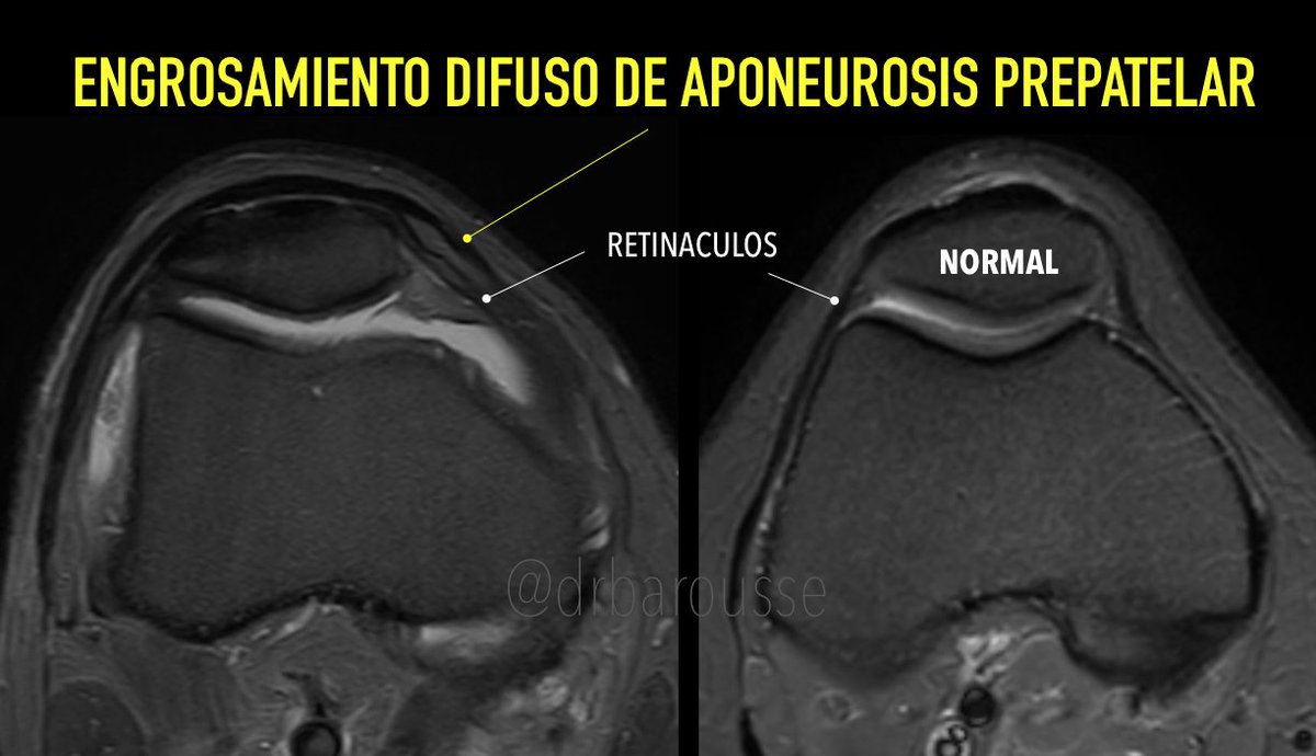 La aponeurosis prepatelar está constituida por la aponeurosis proveniente de los tendones vasto lateral y medial y las fibras superficiales del recto femoral. En este caso futbolista con antecedentes traumáticos crónicos de rodilla. Podría ser un engrosamiento secuelar.