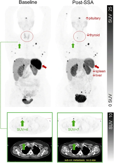 DrMHofman's tweet photo. Saw another patient this week misclassified as progression on DOTATATE PET/CT when the change was likely due to commencement of long-acting octreotide therapy. "Pseudoprogression" under-recognised phenomenon:
https://t.co/kLDWhzUFx1
@globeseek @marklewismd @OncoThor https://t.co/FmvvMBz967