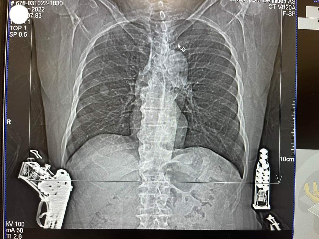 CnlaGandi's tweet photo. Px - Como salio mi radiografia
Yo - Se movió un poco hay que repetirla 😵 https://t.co/FtlFeyRSxU