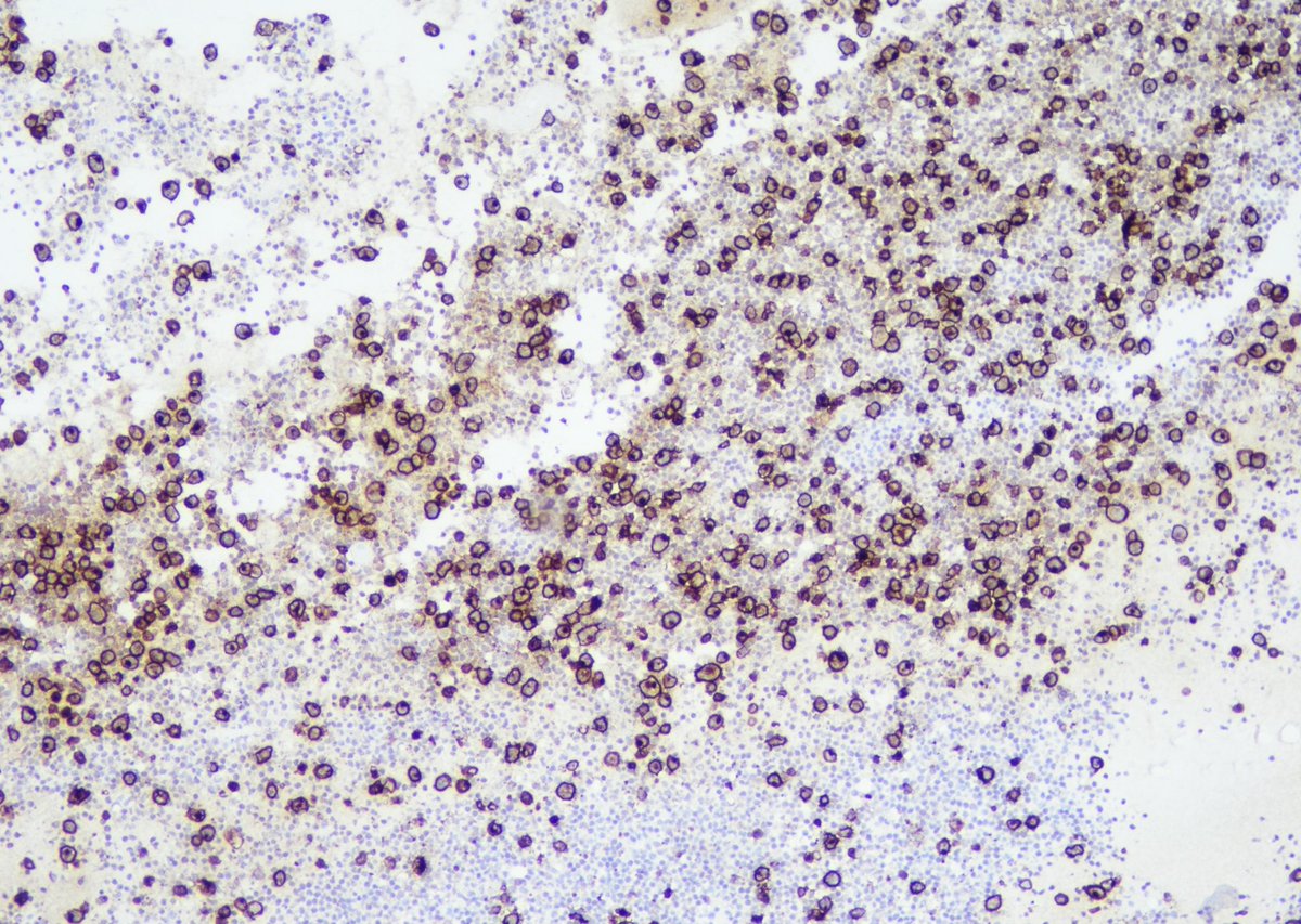9Nr1KCDfUhG9RYO's tweet photo. Follow-up of the case. 35 yo, f, breast implant since 2014. Cytology. Cell-block, IHC. CD 30+(ALK-)
Surgery was performed. Capsule sample CD30+ 
@pepeheffernan @glinglerimek @elsa_borisova @ElmiraKomissar6 @fcschmitt @CancerCytopath @nucleololailo  https://t.co/0x7MRbqRZD https://t.co/YyRj1dRLXW