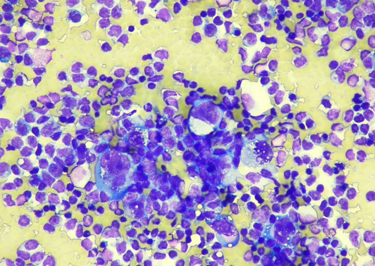 9Nr1KCDfUhG9RYO's tweet photo. Follow-up of the case. 35 yo, f, breast implant since 2014. Cytology. Cell-block, IHC. CD 30+(ALK-)
Surgery was performed. Capsule sample CD30+ 
@pepeheffernan @glinglerimek @elsa_borisova @ElmiraKomissar6 @fcschmitt @CancerCytopath @nucleololailo  https://t.co/0x7MRbqRZD https://t.co/YyRj1dRLXW