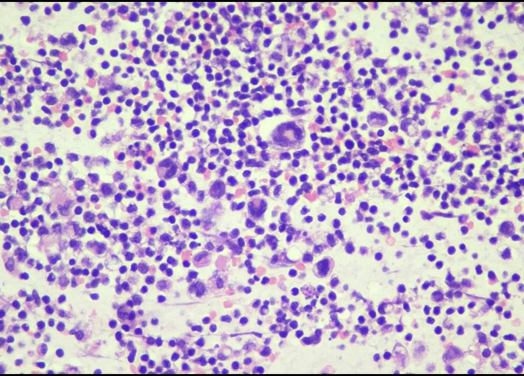 9Nr1KCDfUhG9RYO's tweet photo. Follow-up of the case. 35 yo, f, breast implant since 2014. Cytology. Cell-block, IHC. CD 30+(ALK-)
Surgery was performed. Capsule sample CD30+ 
@pepeheffernan @glinglerimek @elsa_borisova @ElmiraKomissar6 @fcschmitt @CancerCytopath @nucleololailo  https://t.co/0x7MRbqRZD https://t.co/YyRj1dRLXW