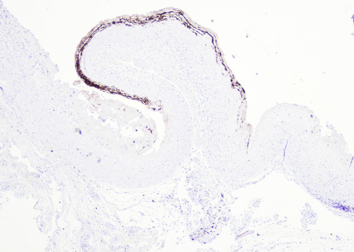 9Nr1KCDfUhG9RYO's tweet photo. Follow-up of the case. 35 yo, f, breast implant since 2014. Cytology. Cell-block, IHC. CD 30+(ALK-)
Surgery was performed. Capsule sample CD30+ 
@pepeheffernan @glinglerimek @elsa_borisova @ElmiraKomissar6 @fcschmitt @CancerCytopath @nucleololailo  https://t.co/0x7MRbqRZD https://t.co/YyRj1dRLXW