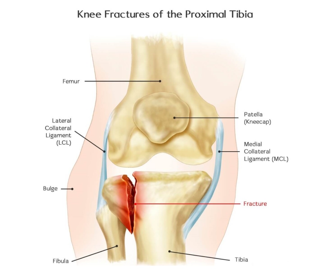 siorasurgicals's tweet image. If a knee fracture gets severe, it may require surgery. A kneecap or a patella is a small bone that connects the thigh bones and your leg bones. 
siiora.com/blogs/knee-fra…
#kneefracture #lockingplatesystem #orthopedic #siorasurgicals #pain #surgery #instruments #medical #health