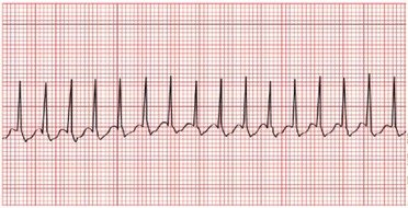 EMNews's tweet photo. #Troponins set the stage for patient harm and don’t even reliably detect #CAD in patients with #SVT. @blakebriggsMD says troponin testing should be done for #patients with concerning #ischemic history but not patients with uncomplicated #SVT. #FOAMed https://t.co/8dea8Sk6un https://t.co/JdBASsKFFF