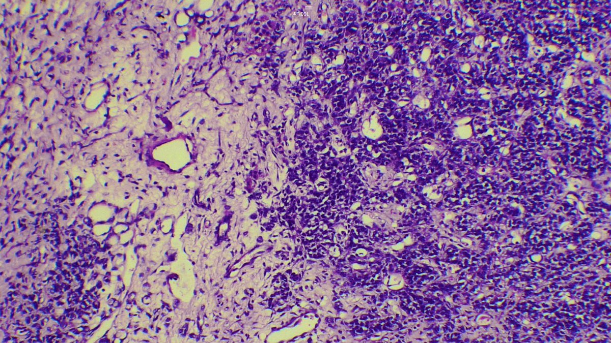 Discover on low magnification only ! ☺️Woman in early 30’s unilateral ovarian lump <a href="/nusrat_xahra/">Nusrat Zahra</a> <a href="/PoloniaAntonio/">A. Polónia</a> <a href="/atman_ci/">Dr. Luca</a> <a href="/kis_lorand/">Lorand Kis</a> <a href="/ariella8/">Celina Stayerman MD</a> #PathTwitter #pathology 1/2