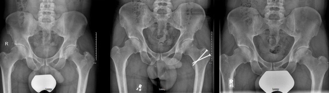 Femoroacetabular impingement surgery provides a lasting improvement in functional scores and an acceptable joint preservation rate of 90.4% at ten years.

#BJO #hip #OrthoTwitter <a href="/ortho_uottawa/">Ottawa Orthopaedics</a> 

ow.ly/rNge50LgcT8
