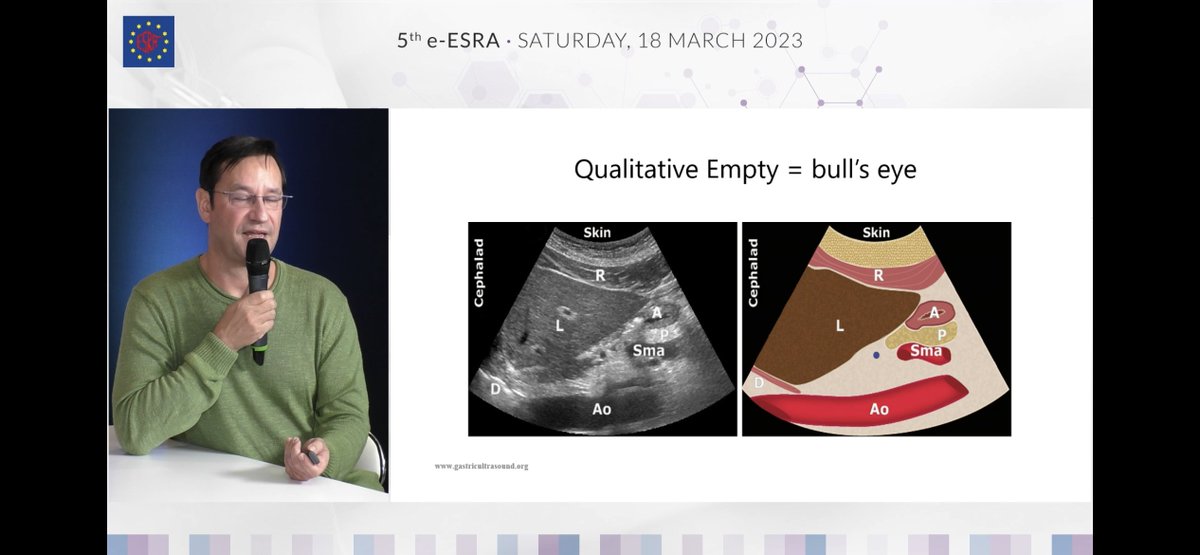 claralexlobo's tweet photo. POCUS session - save lives, says @Steve_Coppens 
death still occurs after gastric aspiration!
Gastric US - What info?
gastric content type &amp; volume amount
Anatomical references
bullseye sign = empty stomach
foster glass = food early stage
Distended antrum =food late stage https://t.co/TLFx5MF2bg