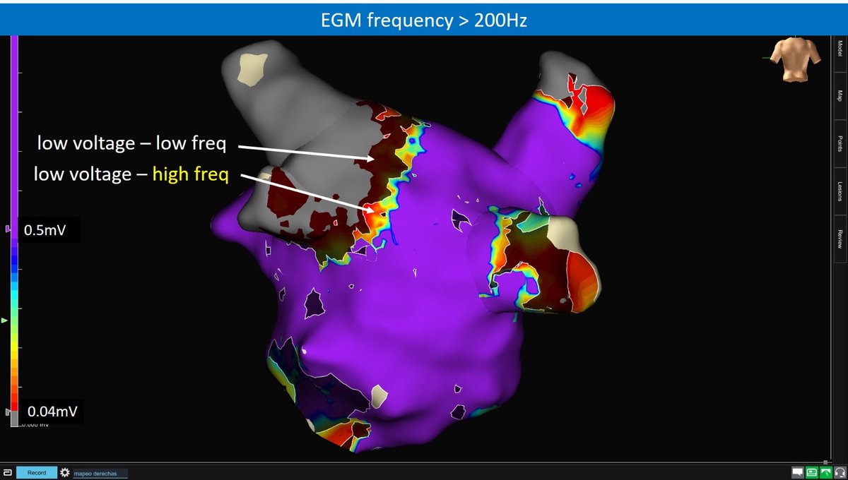 Arritmias H. Ramón y Cajal, Madrid. tweet media