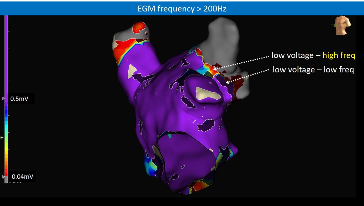 Arritmias H. Ramón y Cajal, Madrid. (@arritmias_hrc) on Twitter photo New EnsiteX NEAR FIELD software for gap identification in AF. Just after left PVs antral ablation, late PV potentials still there. Quick map shows no high frequency EGMs (dark) at posterior aspect inside ablation line (scar 0.04mV) but high freq signals (bright) at upper ridge... New EnsiteX NEAR FIELD software for gap identification in AF. Just after left PVs antral ablation, late PV potentials still there. Quick map shows no high frequency EGMs (dark) at posterior aspect inside ablation line (scar 0.04mV) but high freq signals (bright) at upper ridge...