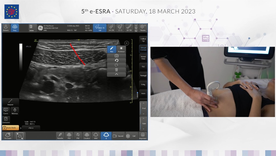 ESRA_Society's tweet photo. So great to watch live demos again on #eESRA2023 👨🔬🔴
Here with @BBreebaart, @Steve_Coppens & @docmorne giving tips and tricks for EDRA
#TAP #RectusSheath #QLB #ESP https://t.co/A4f7mFkT45