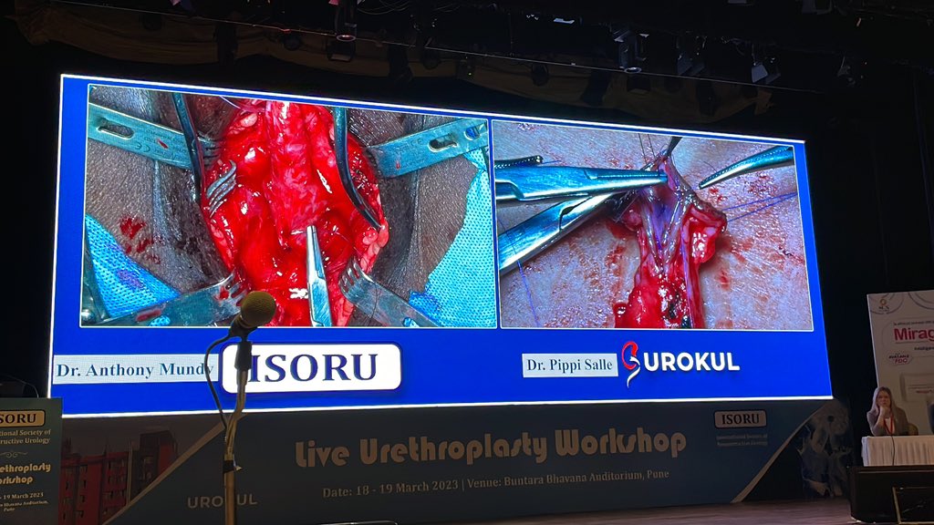 Vincent Tse (@vturodynamic) on Twitter photo Excellent live Urethral recon surgery symposium #ISORU in Pune, India. Hosted by Prof <a href="/sanjaybkulkarni/">Dr Sanjay Kulkarni</a> and <a href="/drjoshi_pankaj/">Pankaj M Joshi</a>. Featuring as well Prof Mundy fr London and Prof Pippi Salle from Brazil. With my colleagues from Hong Kong <a href="/WayneLam_Urol/">Wayne Lam</a> Excellent live Urethral recon surgery symposium #ISORU in Pune, India. Hosted by Prof <a href="/sanjaybkulkarni/">Dr Sanjay Kulkarni</a> and <a href="/drjoshi_pankaj/">Pankaj M Joshi</a>. Featuring as well Prof Mundy fr London and Prof Pippi Salle from Brazil. With my colleagues from Hong Kong <a href="/WayneLam_Urol/">Wayne Lam</a>