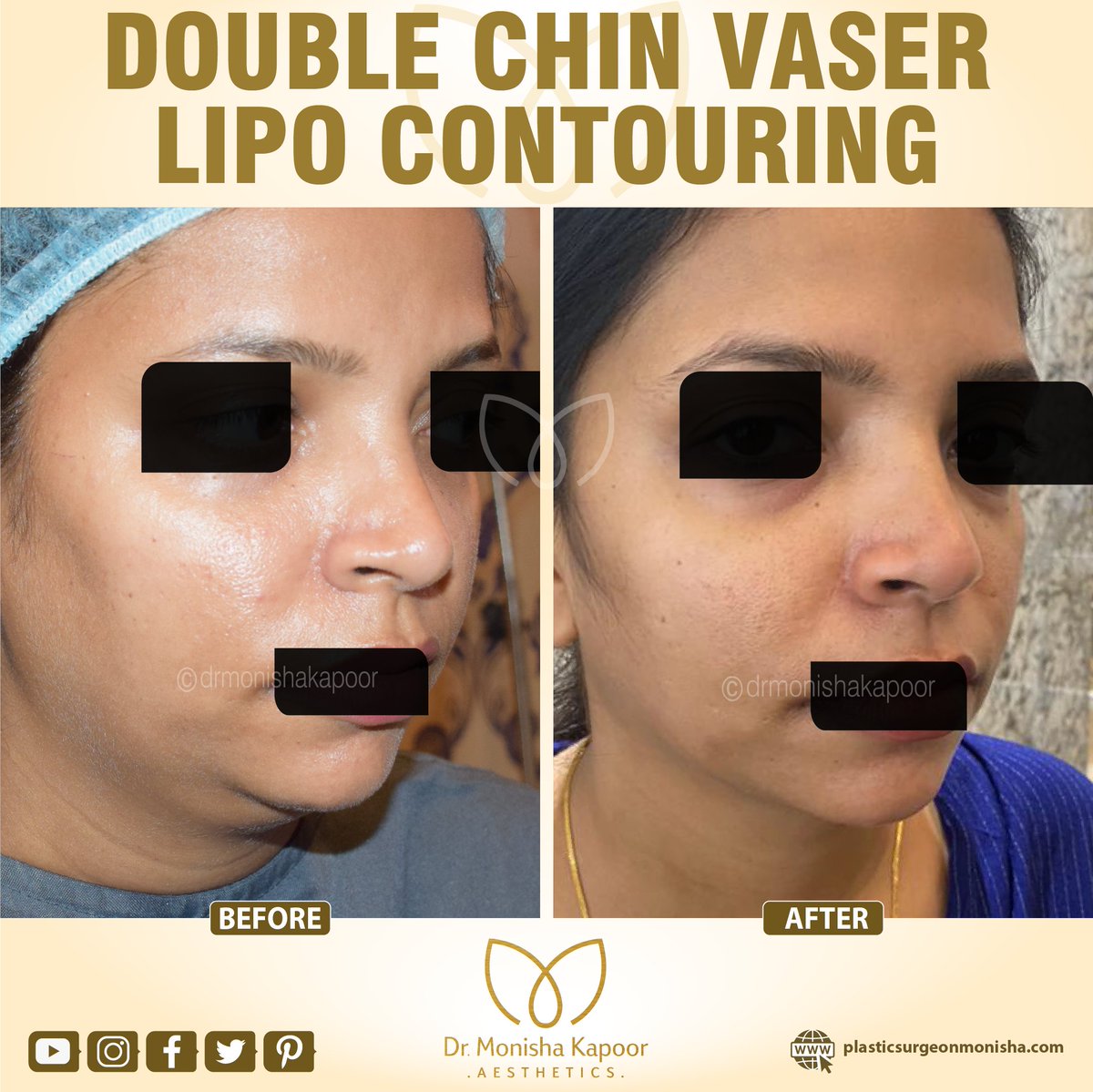 Double chin Liposuction is the best procedure recommended if you are trying to eliminate the excess fat from underneath the chin. With liposuction you start to see the results right away.

#chinremoval #chinliposuction
#chincontouring #chincontour
#plasticsurgery