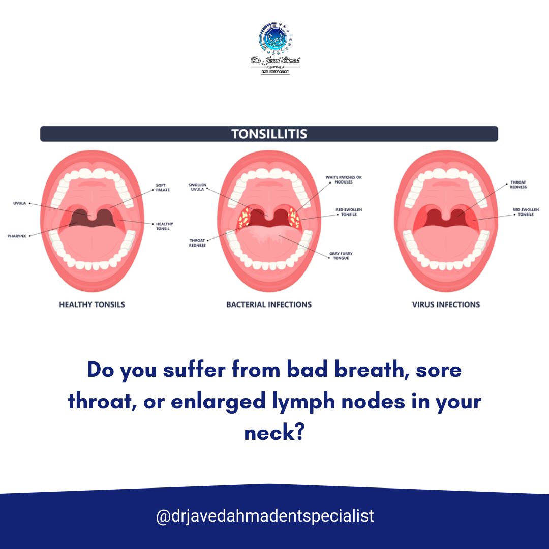 DJavedahmad's tweet image. #tonsilstones #crypts #viral #virus #gland #strepthroat #sorethroat #enlargedlymphnodes #neckpain #swollen #pus #white #mouth #bacteria #Herpes #simplex #HSV #cold #fever #EpsteinBarr #fetid #badodor #oral #laser #ENTspecialist #ENTcare #healthyliving #wellness #healthylifestyle