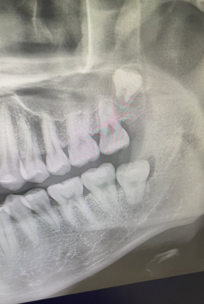 나는 내 치아 마저도 뻔하게 나지 않는구나
