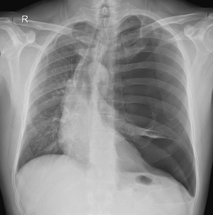 MoreXGrok's tweet photo. A 43-year-old man experienced sudden onset of chest pain and shortness of breath onboard a domestic flight

 👉respiratory distress and apprehension.

Diagnosis? https://t.co/E13MtNkuso