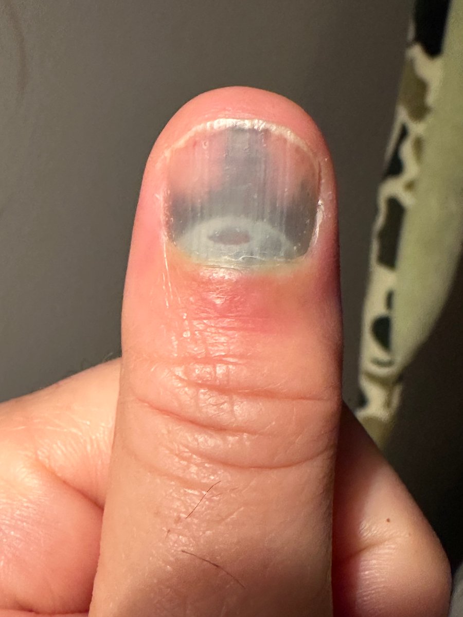 jasontitus's tweet image. Beware the auto-closing doors of Teslas!  I had to hold the door to let a car pass and our Model X decided it had to pull the door closed on my thumb. Spent my afternoon getting X-rays and such.  #badsoftware @Tesla @elonmusk