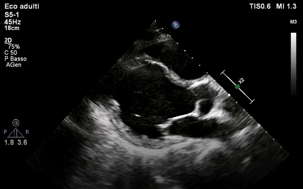 💡🫀ICOT Clinical case of the week🫀🧠

💡UNO STRANO CASO DI MALATTIA ARITMOGENA AD INTERESSAMENTO BIVENTRICOLARE…O FORSE NO?💡
🧠 Alma Mater Studiorum Università di Bologna.

❗️Leggi il caso clinico completo 
italiancot.it/2023/03/18/161…
#cardiology #echocardiography  #ITcardiology