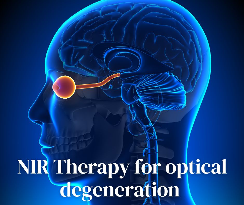emf_native's tweet image. 👁️💡⚡ Revolutionize your eye health with the power of near-infrared light! 🙌🏼 Learn how this therapy can promote cellular repair and regeneration, reduce inflammation, and stimulate nerve growth. #NIRlighttherapy #eyehealth 👀✨

Read More: loom.ly/klYbAFc