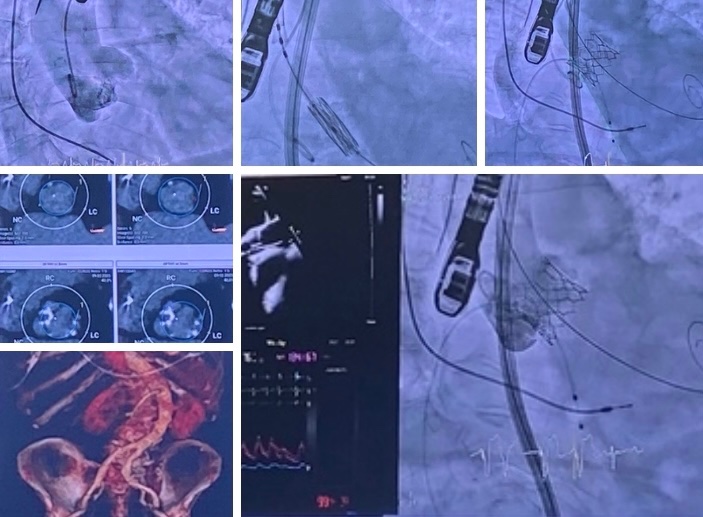 #LiveCase Sant Pau #CSCEstructural 

#Scoliosis #Bicuspid severe calcified aortic valve type I R-N flare with calcified raphe #CircleMethod

#TAVR with a balloon-expandable 26mm THV #Sapien3 Ultra

Outstanding final results. No PVL. No gradient. Future coronary access.

#CSC2023