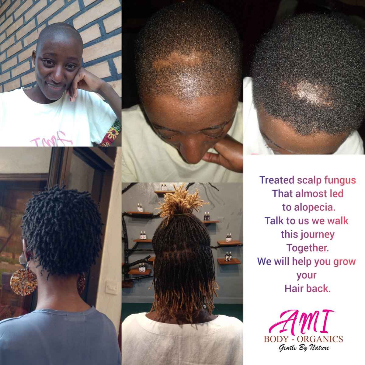 I have found myself being a patient of my own Treatment,and I love how this chose to BE.
I am a Testimony that healthy hair is Possible and Alopecia can and  is curable.
We have helped a lot of women and Men grow back their hair, you too you can . Call us on +250785751261