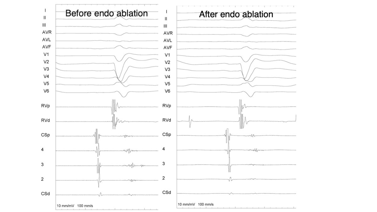 Chagasic pt, previous epicardial ablation presents w VT recurrence. Epicardial approach in redo procedure not possible due to extensive adhesions. Near abolition of late potential in CS catheter after endo ablation. Be aware of alternative ways to approach difficult substrates.