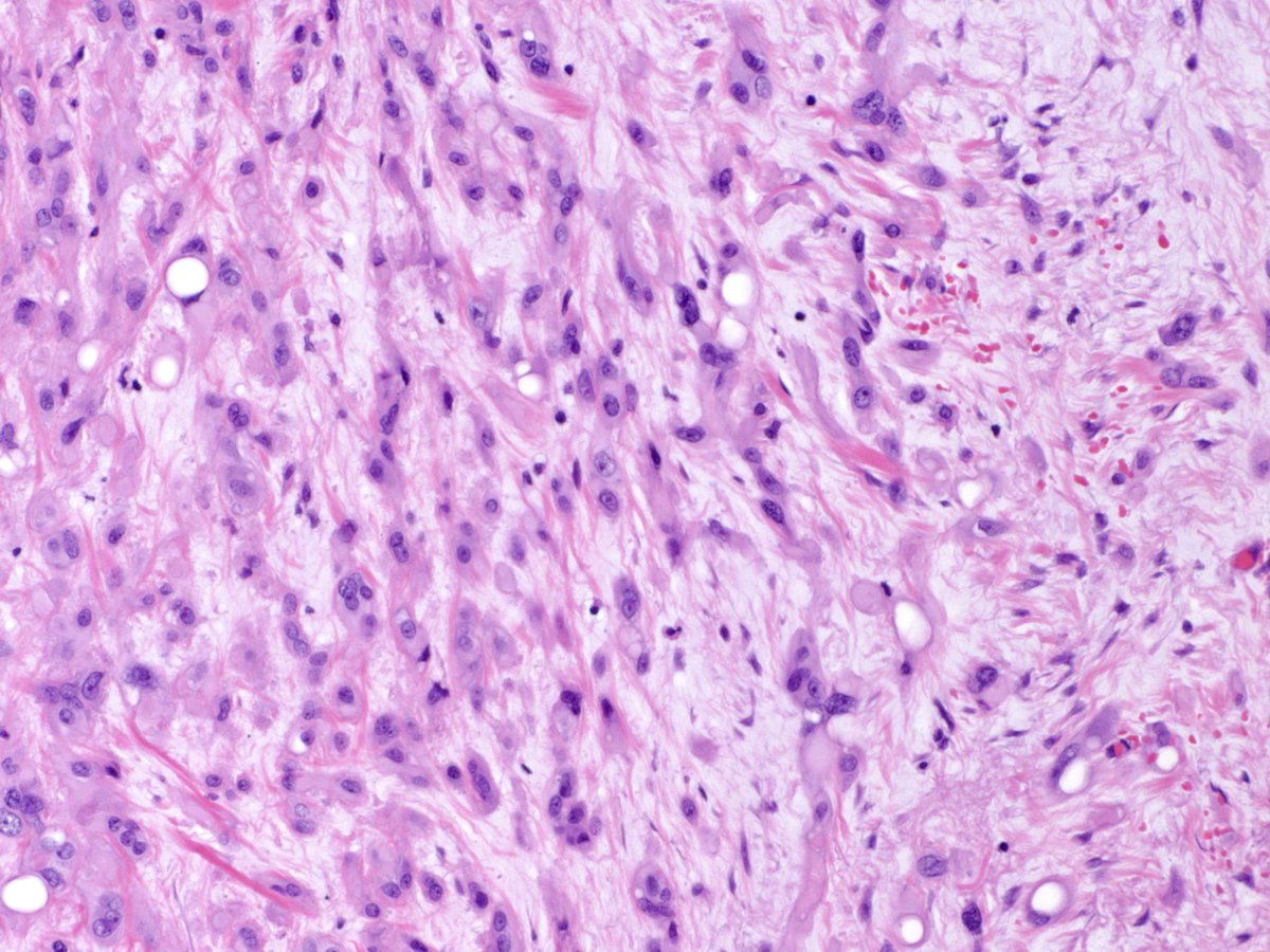 MonicaGarciaBu2's tweet photo. Another amazing case... a young woman with a history of IBD and an irregular thickening in the colon- An unexpected neoplasm with classical histology.  
What is your diagnosis?  @usgips @umiamipathology @FLPathologists @Pathologists #pathresidents #pathology https://t.co/lwZiz1LsBK