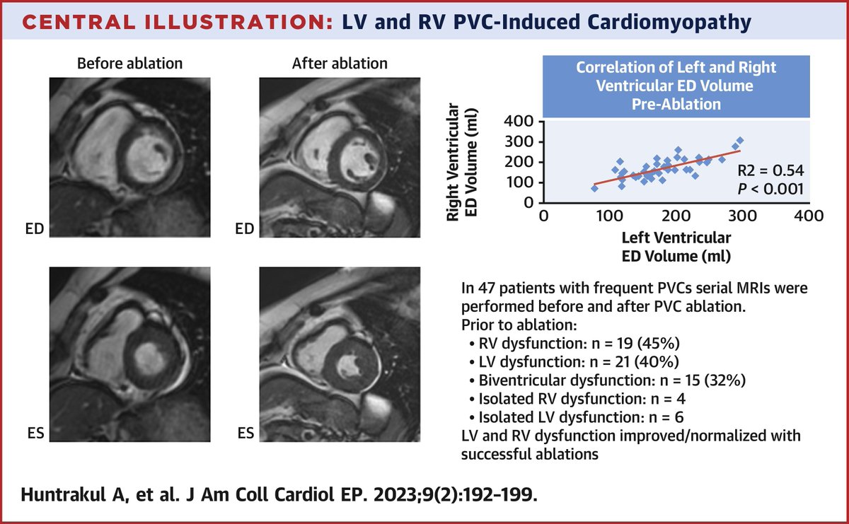 Frequent premature ventricular complexes can cause right ventricular cardiomyopathy that parallels left ventricular cardiomyopathy and is reversible with successful ablation. bit.ly/3mSd92a

#JACCCEP #EPeeps #CardioTwitter