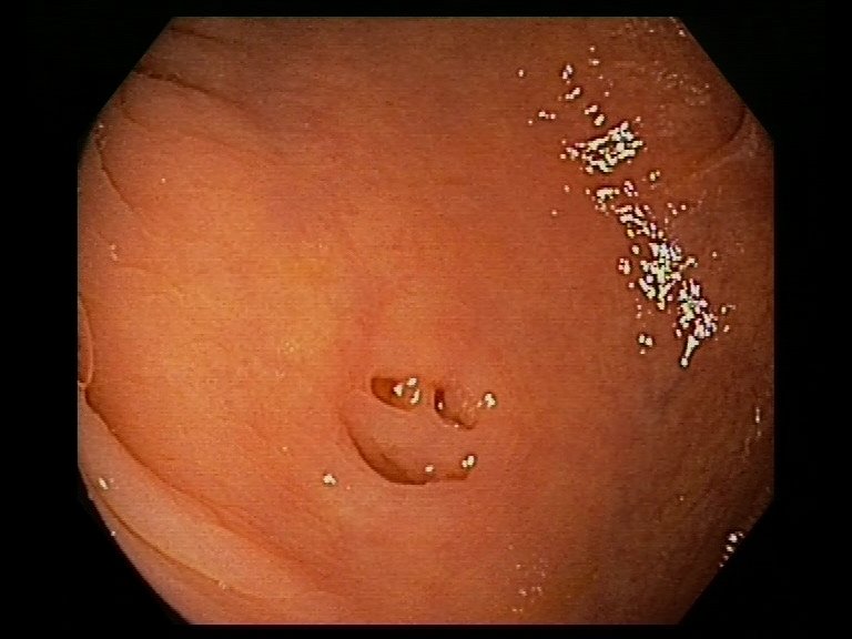 gram_negativo's tweet photo. Isn't this the happiest diverticulum you have seen? 
#GITwitter #endoscopy https://t.co/DBLPeAtOah