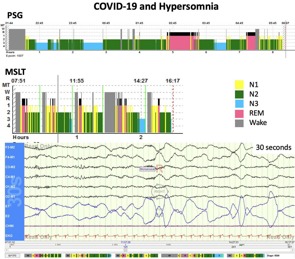 SleepyNeuroDoc's tweet photo. COVID + Hypersomnia. Adult female. FHx: type 2 narcolepsy. After COVID infection initially slept 15h/day, then transitioned to 10h/day with excessive daytime sleepiness, hypnagogic hallucination + sleep paralysis, and occasional onset insomnia + nocturnal awakenings. No cataplexy https://t.co/BFuOTSENdE