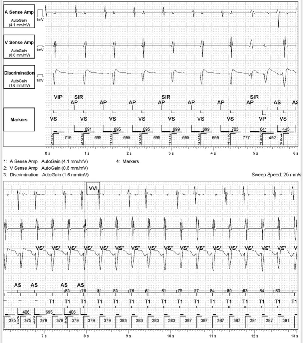 Going through device checks. Interesting event. Thoughts on initiation and implication for mechanism of the tachycardia? #EPeeps