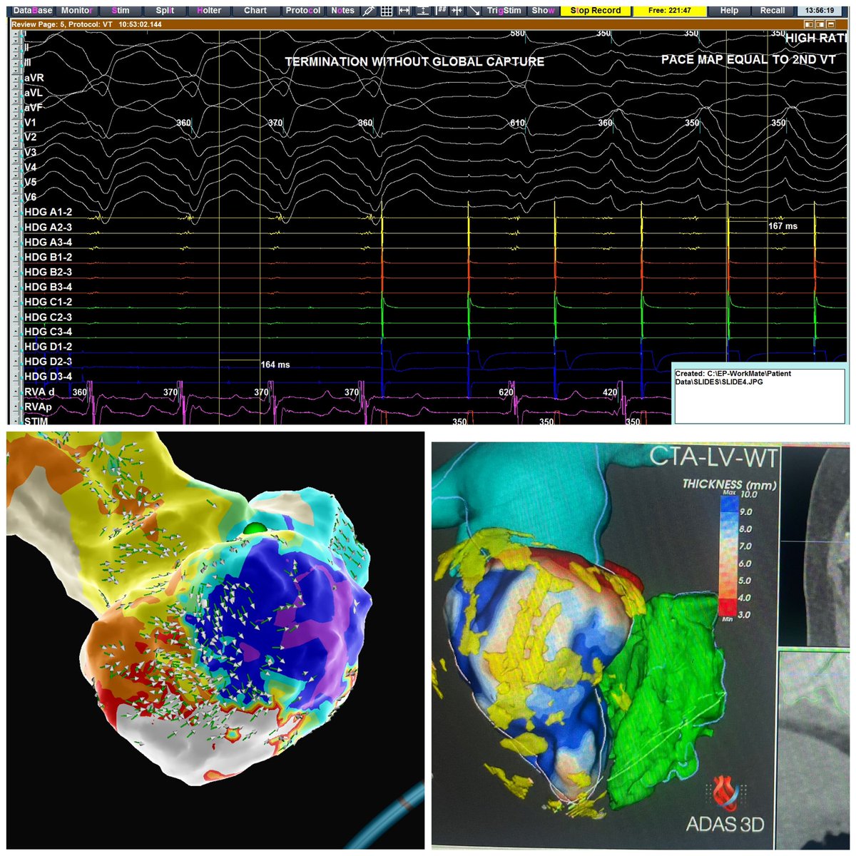 EffieNitsdoc's tweet photo. #ablatevt #EPeeps old school vs new school! Termination without global capture at mid diastolic for VT 1 followed by capture of mid diastolic potential and VT 2 morphology! #deepmapping #adas @ivroca , see the thread for the journey and futility of voltage based approach https://t.co/NnGcQWRZnm