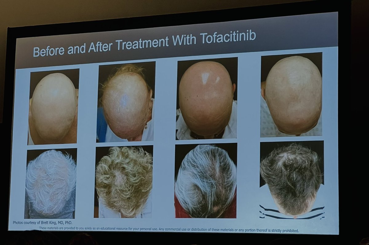 A whole new world for thousands of patients facing #alopeciaareata globally. Small molecules, more specifically JAK inhibitors, are changing the disease’s paradigms @AADmember @AADskin #AAD2023